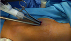 Chirurgia toracica mininvasiva (e UNIPORTALE)